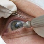 cirurgia-que-altera-cor-do-olho-tem-uso-restrito-para-pessoas-cegas