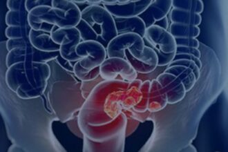 estudo-projeta-aumento-de-36%-em-mortes-por-cancer-colorretal-ate-2040